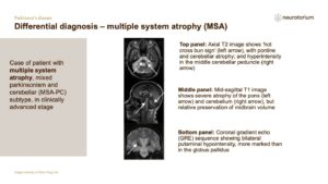 Differential diagnosis – multiple system atrophy (MSA)